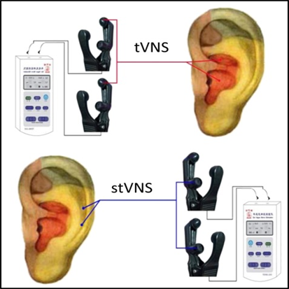 迷走神經刺激術與憂鬱症治療