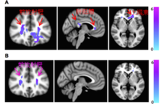 MDD患者補充N3多單元不飽和脂肪酸的白質變化